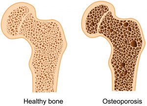 osteop1